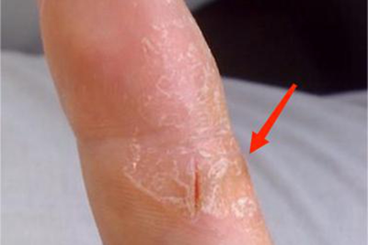 甲状腺功能减退症皮肤增厚图