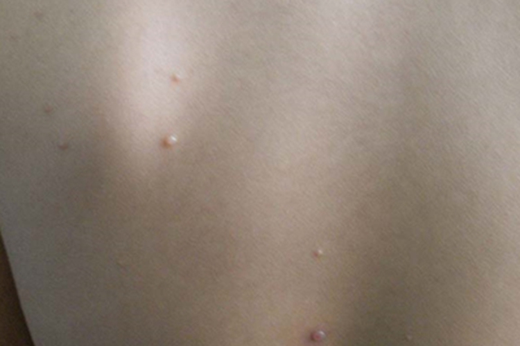 传染性软疣背部症状图