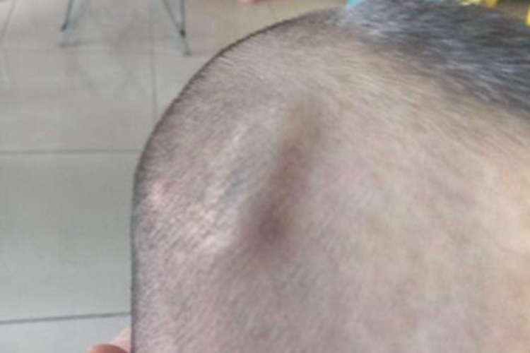 皮下血肿头上一个肿块图 皮下血肿头上一个肿块图