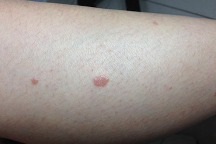 扁平疣样职业性疣赘小腿丘疹图