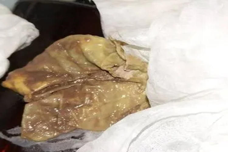 用甲硝唑栓剂排出脏东西图 用甲硝唑栓剂排出脏东西图