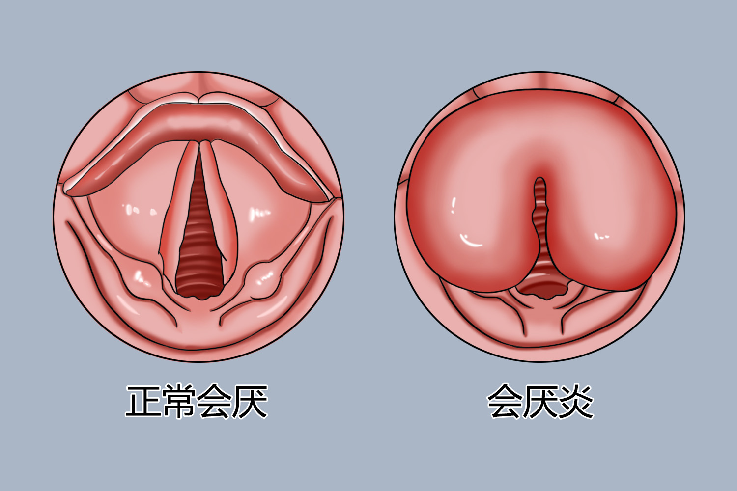 正常会厌和会厌炎对比手绘图