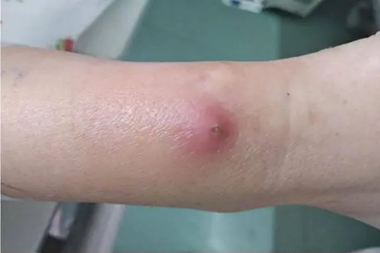 穿刺点感染红斑图