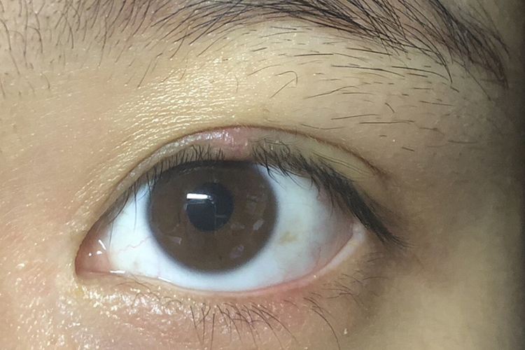 麦粒肿基本痊愈图