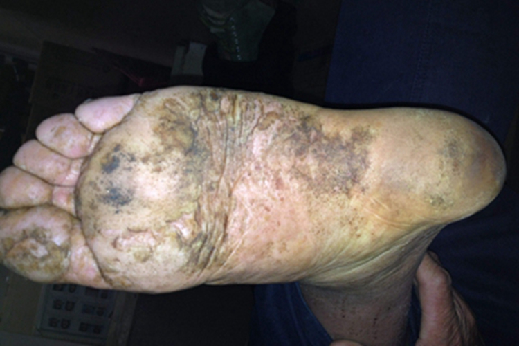 进行性掌跖角化病脚底皮肤增厚图