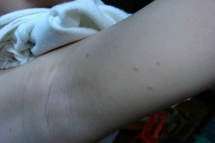 腋下传染性软疣图