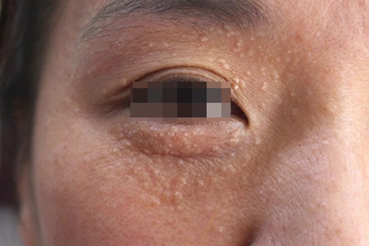 汗管瘤眼周丘疹图