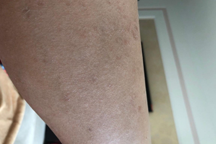 慢性苔藓样糠疹小腿皮肤粗糙图