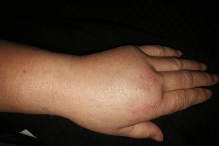 血管性水肿手背水肿图 血管性水肿手背水肿图