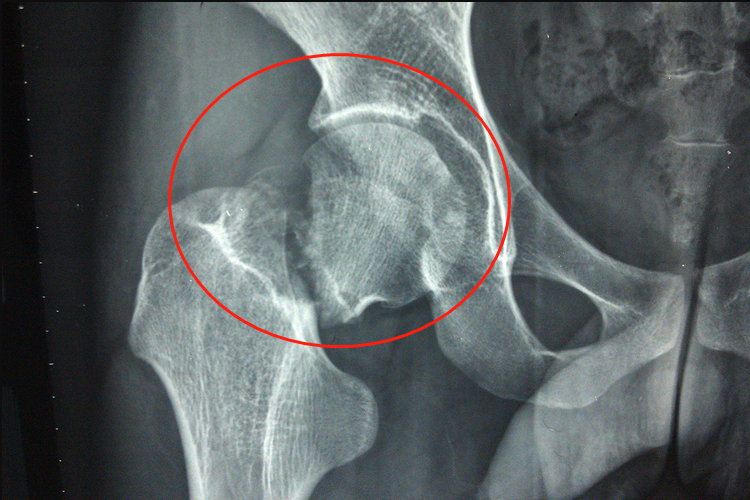 嵌插骨折示意图