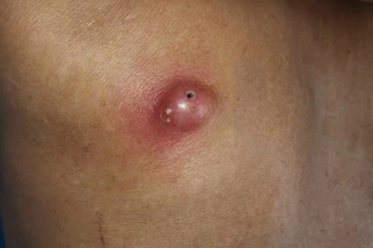 疖背部症状图 疖背部症状图