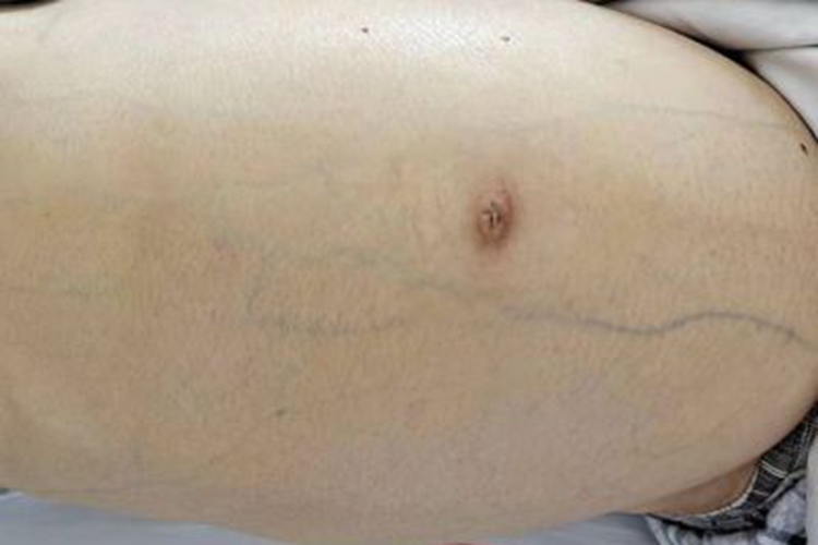 肝硬化腹部膨隆图