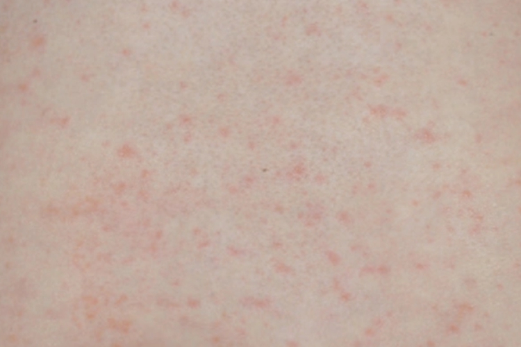 伤寒玫瑰疹图 伤寒玫瑰疹图
