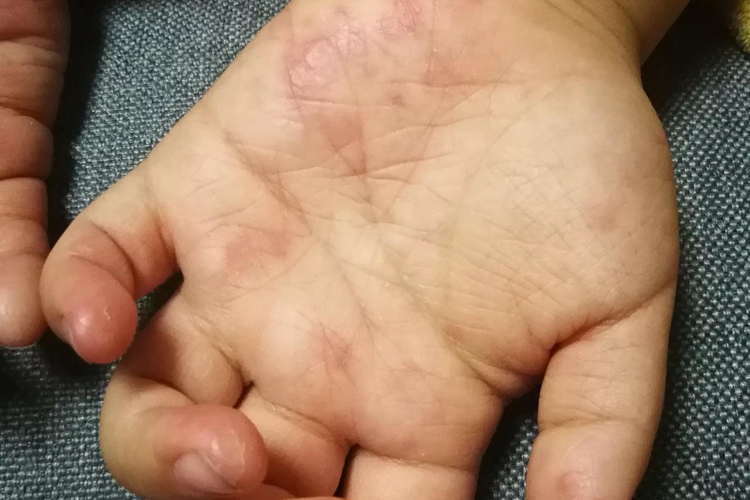 儿童期特应性皮炎手掌小红疙瘩图 儿童期特应性皮炎手掌小红疙瘩图