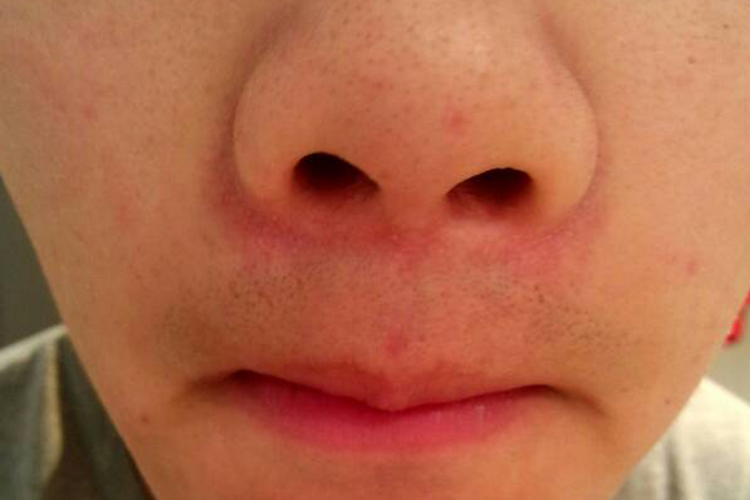 擦伤鼻子下方红红的图 擦伤鼻子下方红红的图