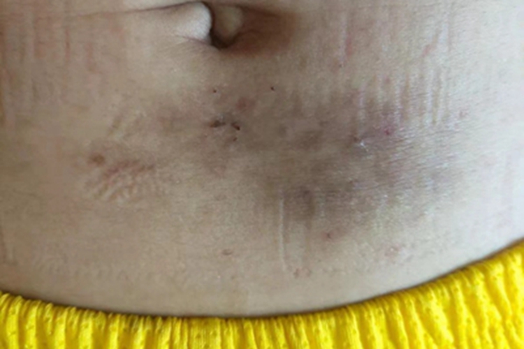 刺激性接触性皮炎皮肤发黑图