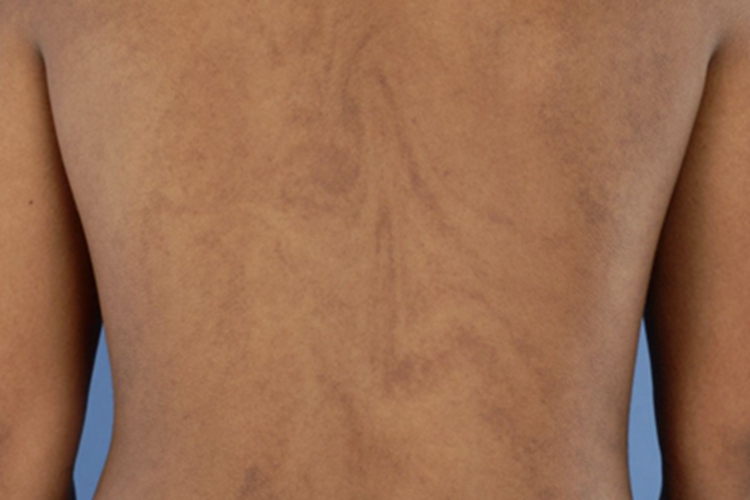 脱色性色素失禁症斑图