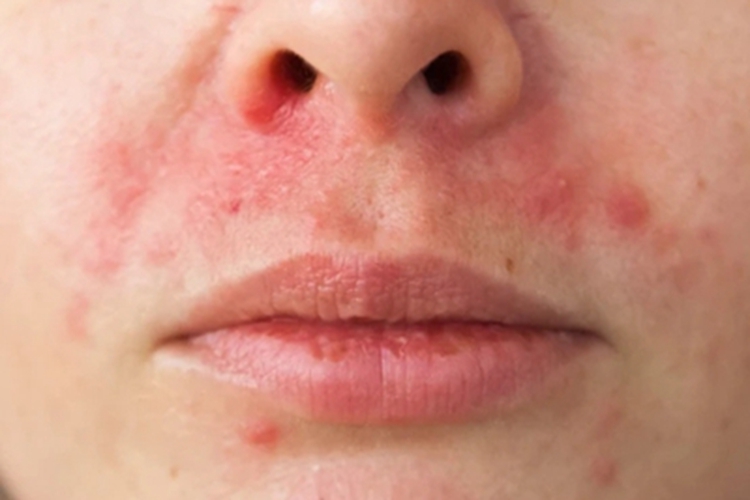 口周皮炎口周疙瘩图