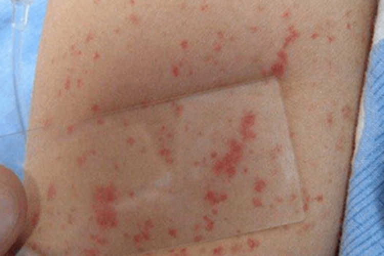 过敏性紫癜胳膊红斑图