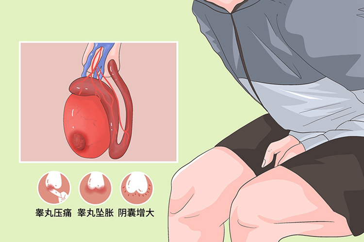 睾丸结石症状图 睾丸结石症状图
