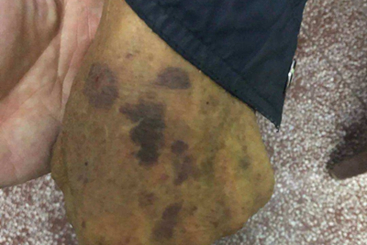 老年性紫癜手背紫斑图