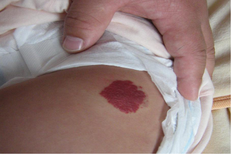 小儿血管瘤臀部症状图