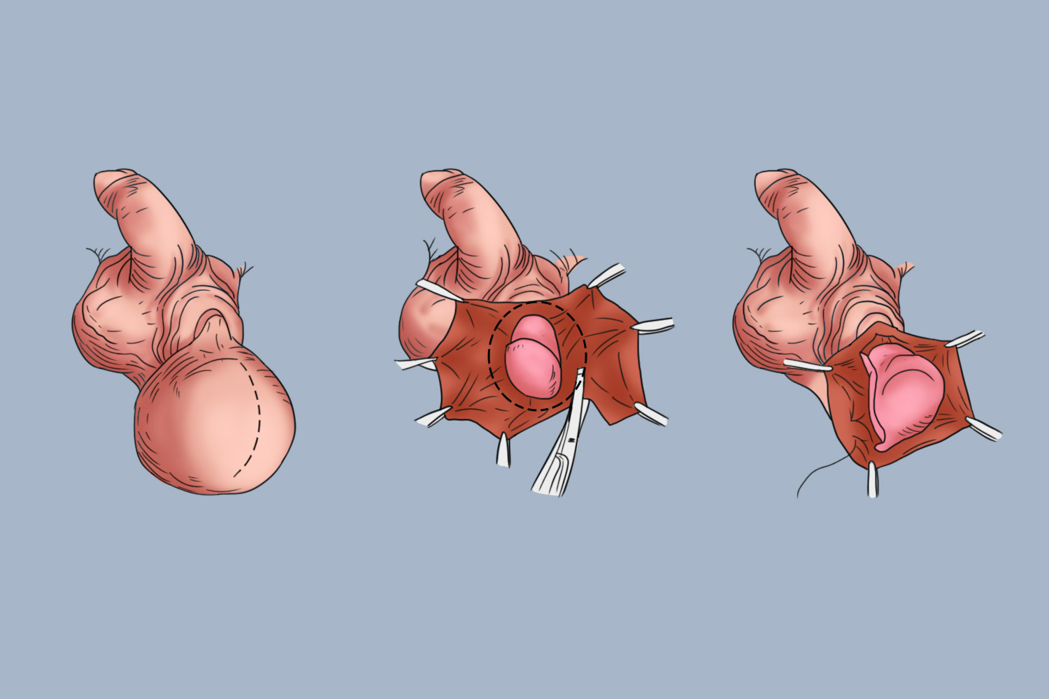 睾丸鞘膜翻转术缝合前图