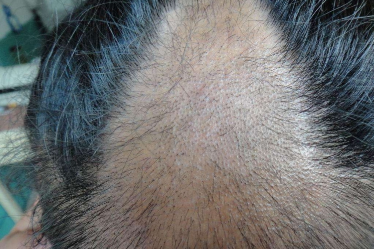 头生疮黑点癣图