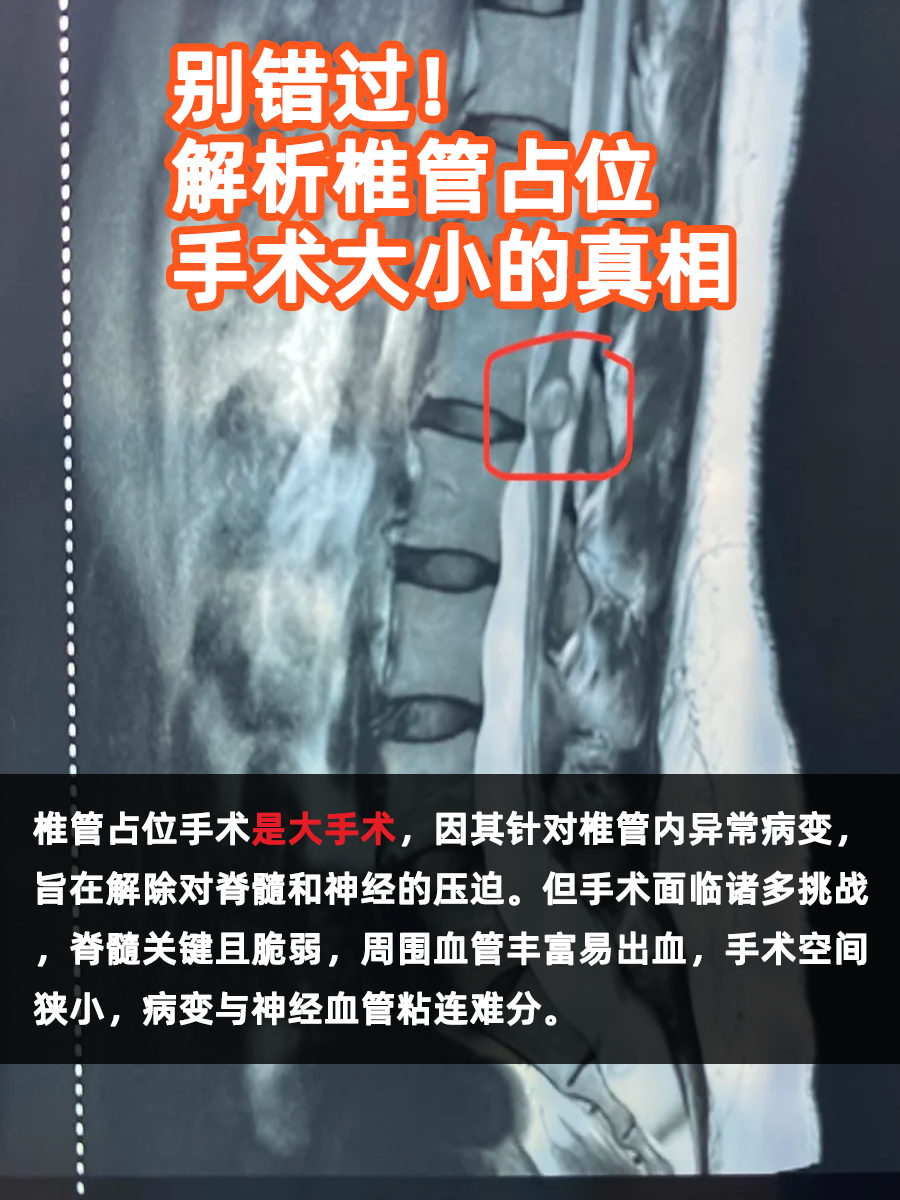 别错过！解析椎管占位手术大小的真相