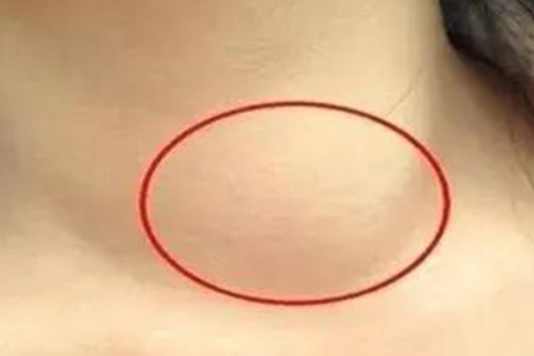 急性喉炎大包图