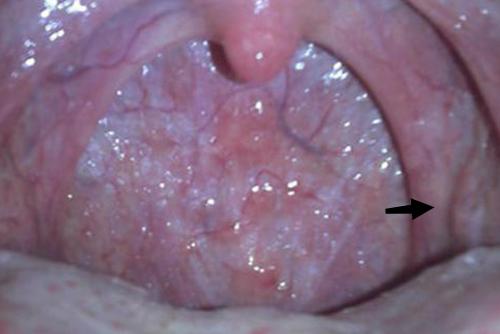 5岁儿童正常扁桃体图