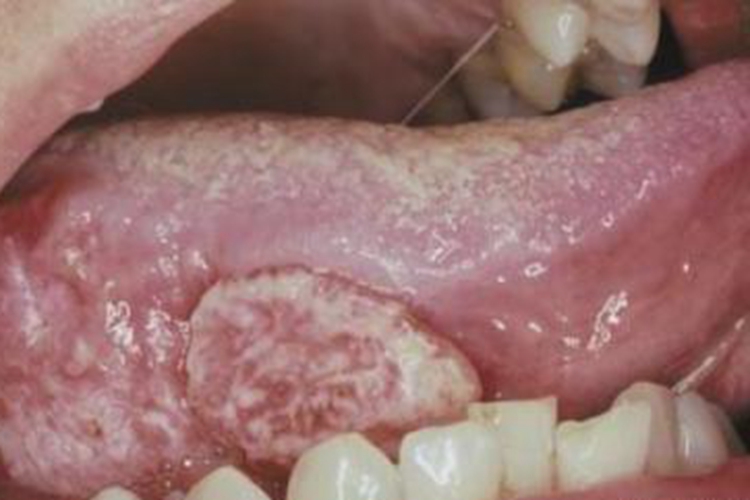 口腔癌舌侧症状图