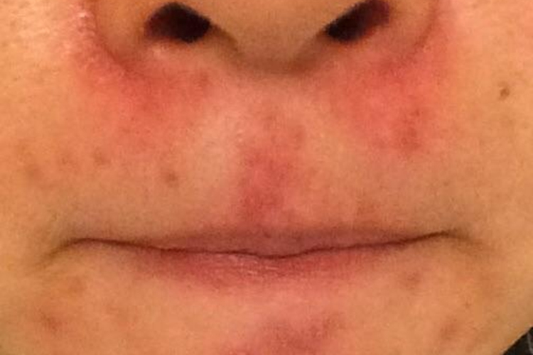 脂溢性皮炎鼻子下面发红图