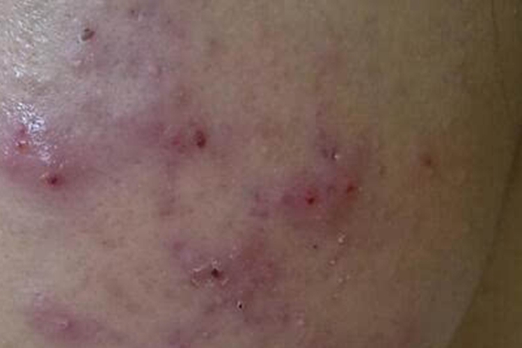 聚合性痤疮面部有疙瘩血痂图 聚合性痤疮面部有疙瘩血痂图