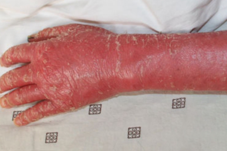 红皮病急性期手背脱皮图