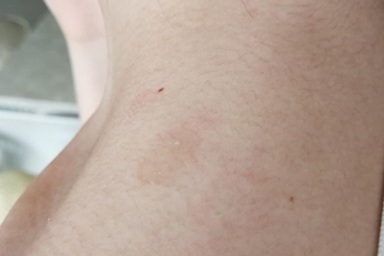 花斑癣肩膀上长了好几块斑图 花斑癣肩膀上长了好几块斑图