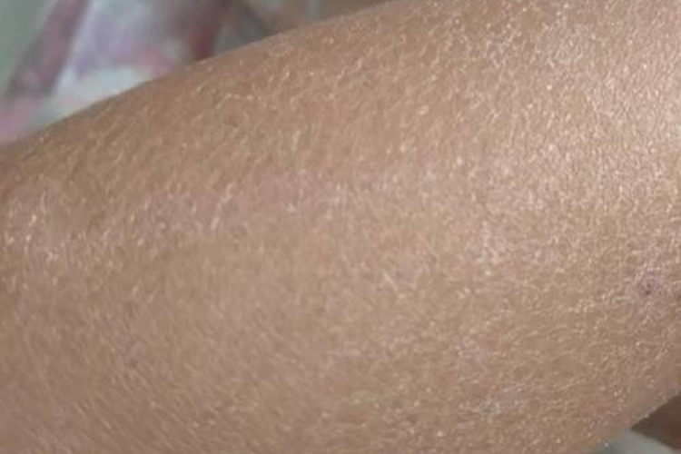 皮肤干燥胳膊上起皮屑图