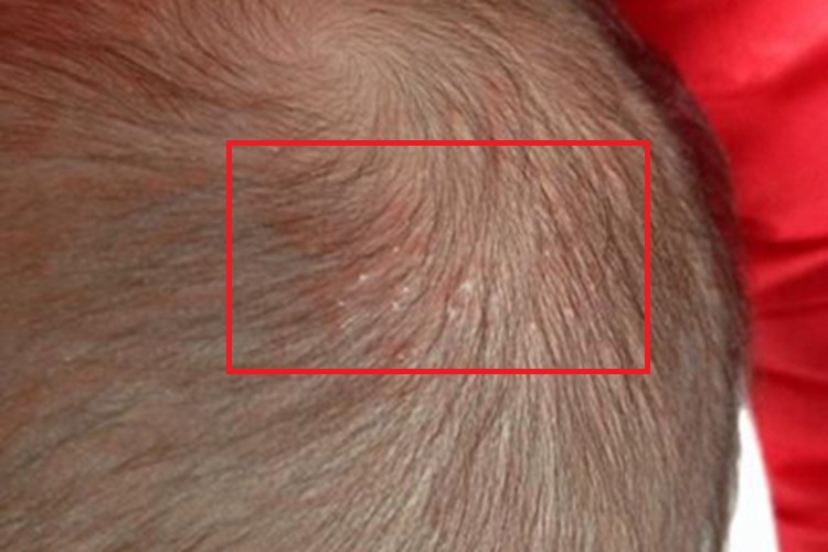 渗出型婴儿湿疹头皮水疱图