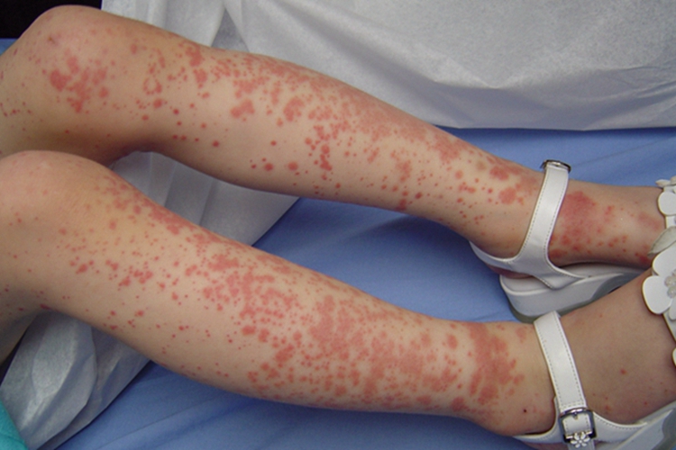 小儿过敏性紫癜小腿上遍布红斑点图