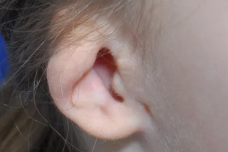 外耳畸形Ⅱ型图