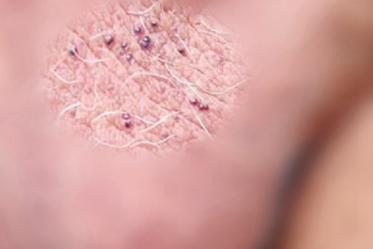 阴囊血管角化瘤小红疙瘩图