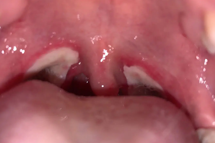 小舌头变长下垂图