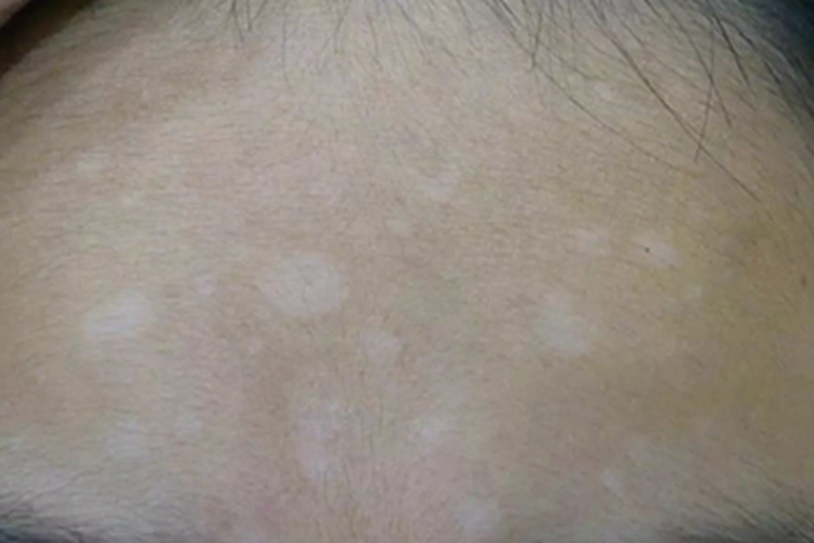 贫血痣前额症状图 贫血痣前额症状图