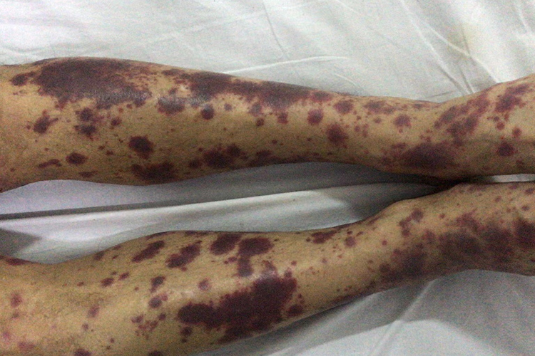 继发性或症状性血小板减少性紫癜图