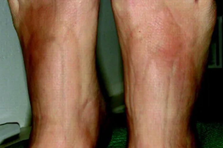 嗜酸性筋膜炎脚背条纹图