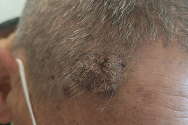 寻常疣头皮皮肤粗糙图 寻常疣头皮皮肤粗糙图