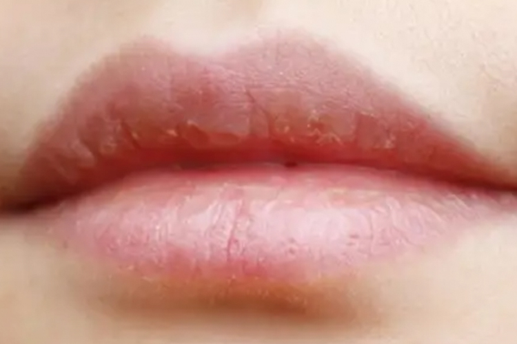 唇炎干燥症状图