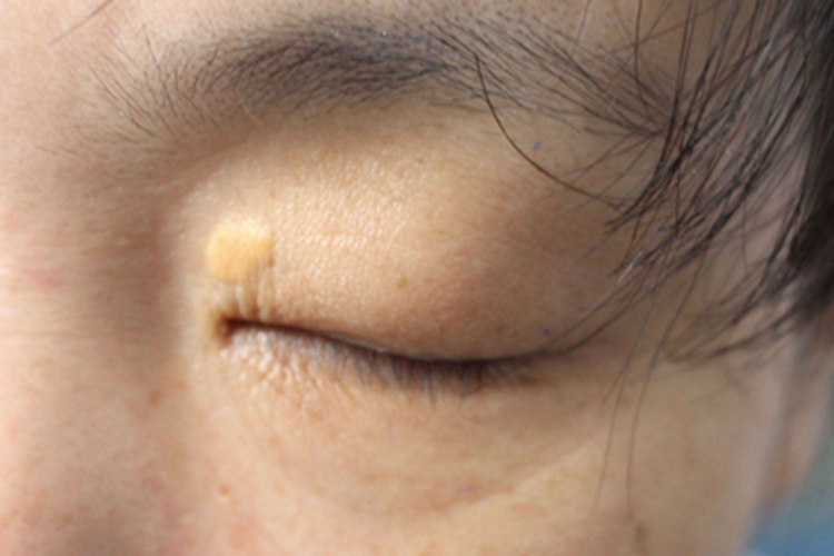 结节性黄瘤圆疙瘩图