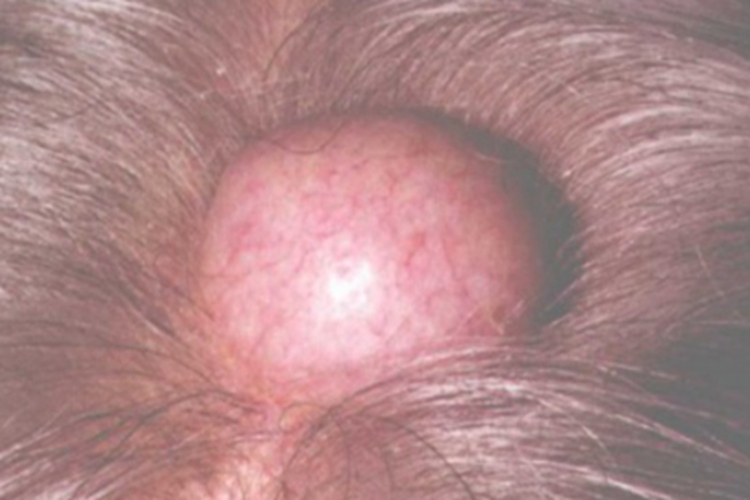 表皮样囊肿头皮症状图