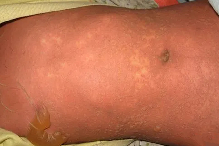 水疱可移动图 水疱可移动图